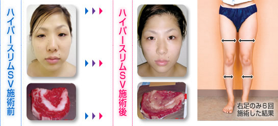 ハイパースリムSV施術前後の写真イメージ